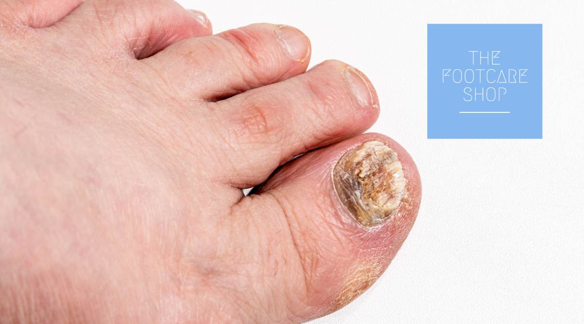 Fungal Nail Infections Prevention and treatment The Foot Care Shop