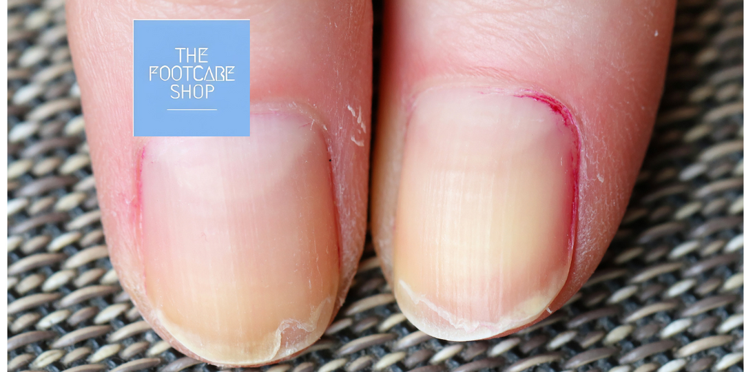 What Causes Ridges & Splitting Of Nails?