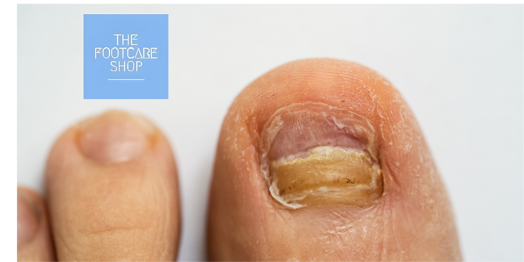 Understanding Fungal Nail Infections: Causes, Prevention and Treatment.