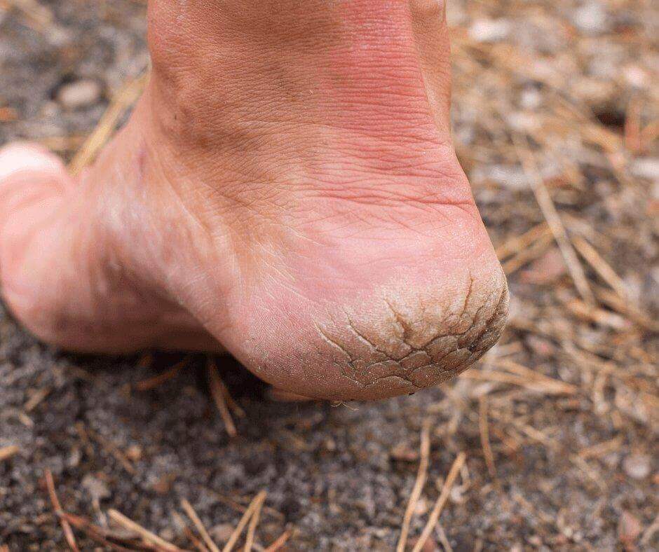Best creams for dry and cracked heels – podiatrist guide
