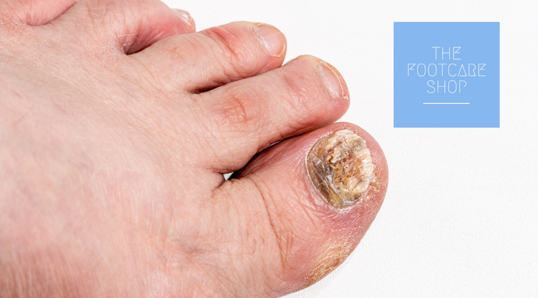 Understanding Fungal Nail Infections: Causes, Prevention and Treatment