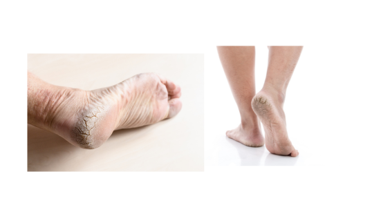 Best Foot Creams Australia