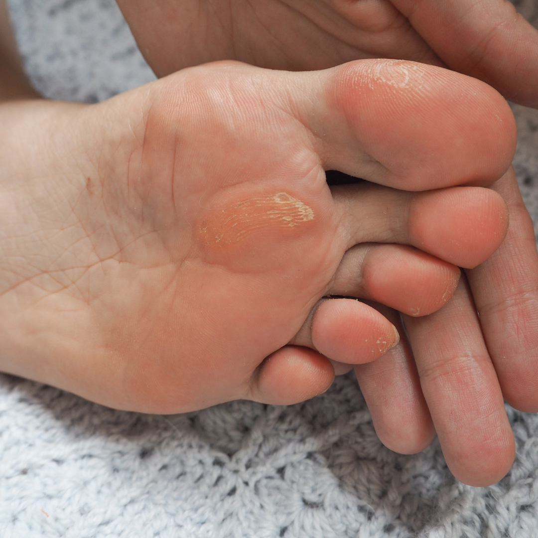 Understanding Calluses: Causes, Prevention, and Treatment