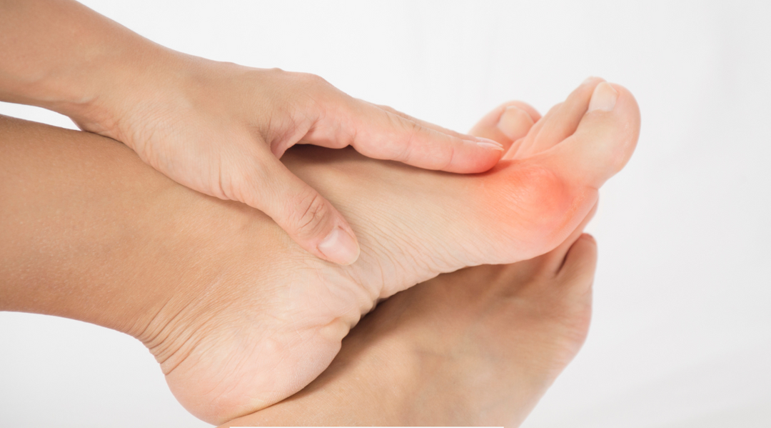 What Are Bunions and How to Treat Them