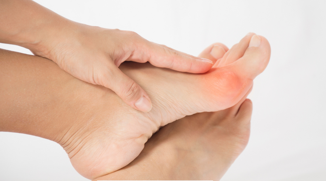 What Are Bunions and How to Treat Them a podiatrists perspective